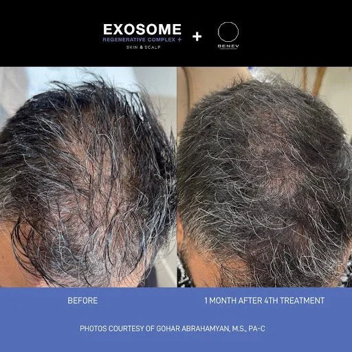 Benev EXOSOME REGENERATIVE COMPLEX 50億外泌體 - 5SKINLAB