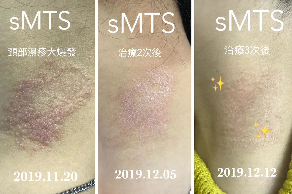 SMTS 幹細胞嬰兒針家用療程 水晶針x10 SMTS精華 面膜 防曬 洗面奶 - Beauty’s 5skin