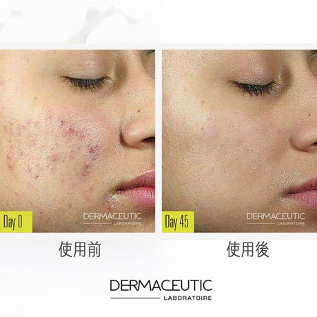 DERMACEUTIC MilkPeel Treatment Kit 奶滑果酸煥膚套盒 - 5SKINLAB