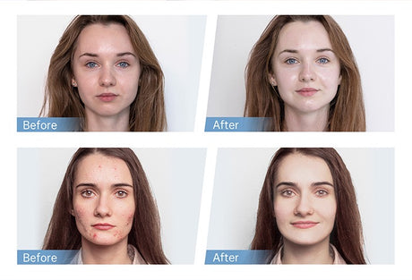 skinlabhk.myshopify.com Hydra.pen H5 Professional MTS 微電流EMS電動微針Microneedling Hydrapen