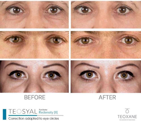 TEOXANE TEOSYAL REDENSITY® 1/2熊貓針 - 5SKINLAB