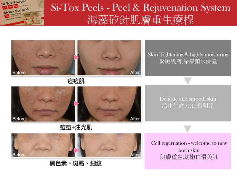 Lipodermis 海藻矽針 Si-Tox Peels - Peel & Rejuvenation 26年 TA/TA2/TA3 - Beauty’s 5skin 